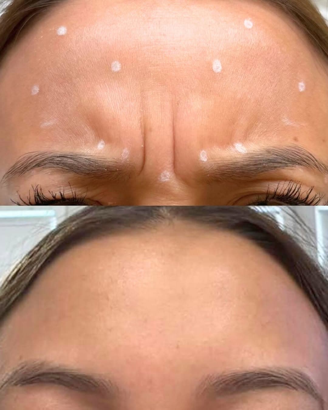 Anti-Wrinkle treatment at Mastery of Aesthetics Bedfordshire