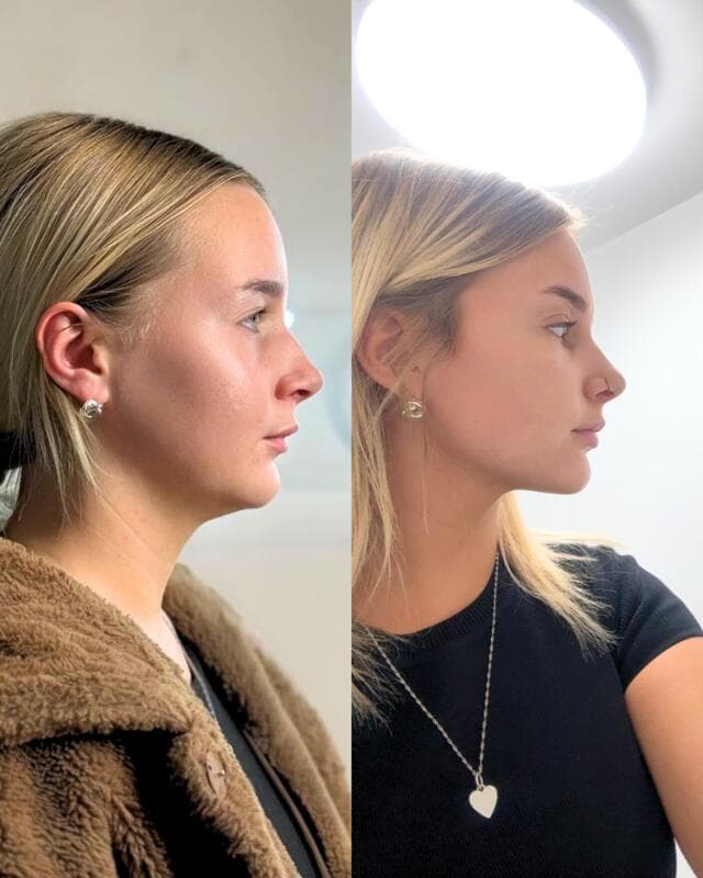 Lemon Bottle treatment at Mastery of Aesthetics Bedfordshire